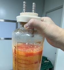 延边水动力吸脂手术要做多久？
